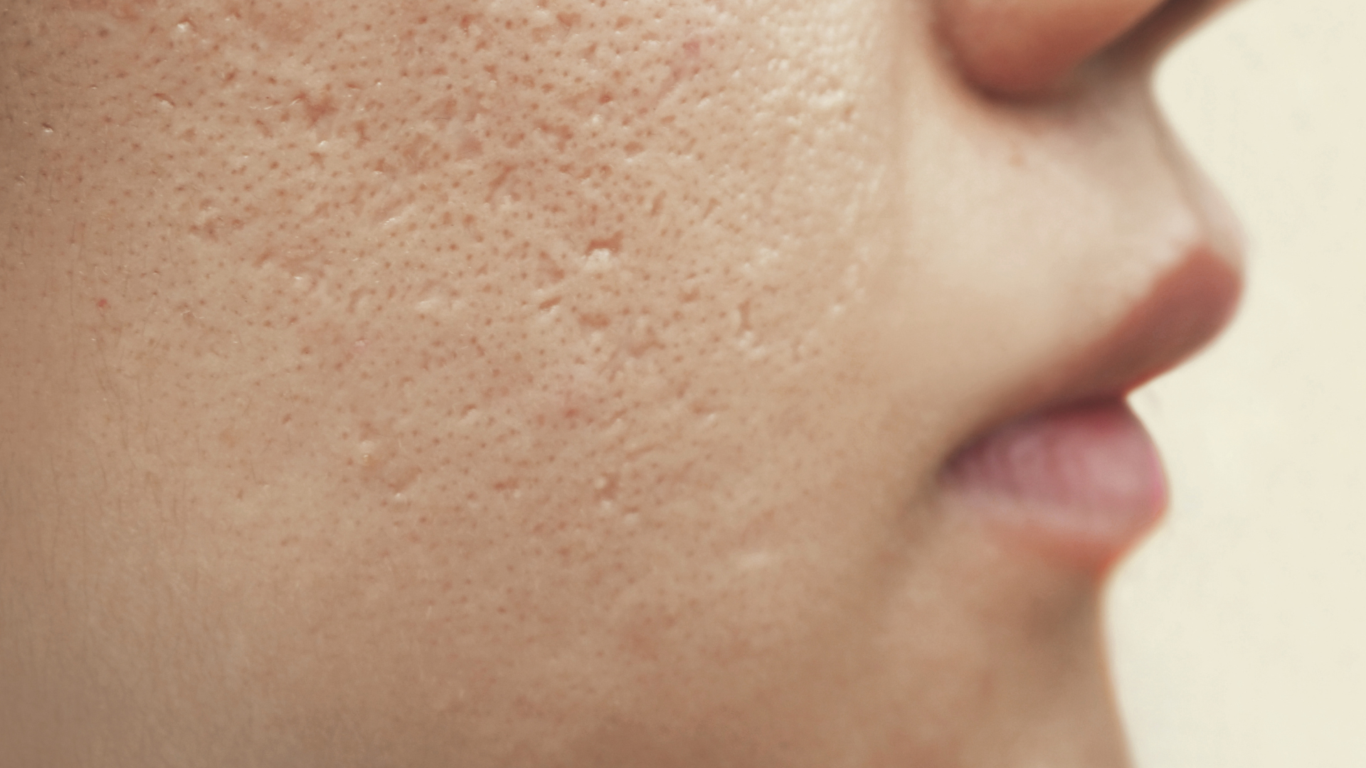 cicatrices de acne